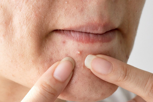 how-to-get-rid-of-pimples-2