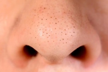 How to remove blackheads on the nose at home?