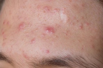 How To Get Rid Of Forehead Acne Naturally?