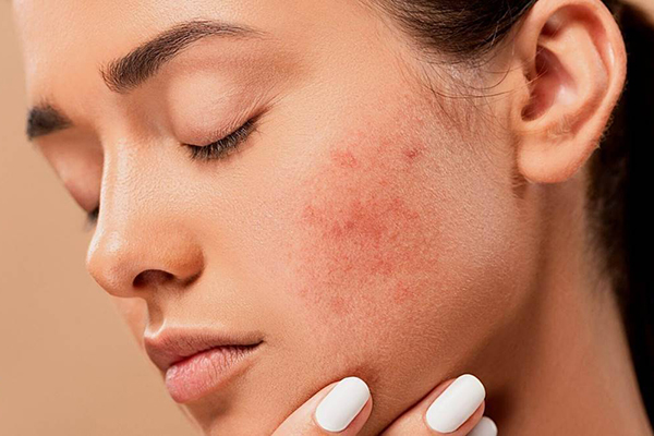 what-are-the-best-treatments-for-acne
